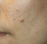 Mole Removal