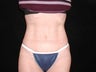 45 Year Old Female Mini Tummy Tuck
