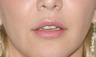 Upper Lip Lift, Fat Transfer and Lower FATMA