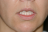 Upper Lip Lift, Fat Transfer and Lower FATMA