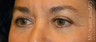 Eye Bags Treatment