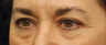 Eye Bags Treatment