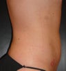 SmartLipo MPX