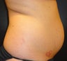 SmartLipo MPX