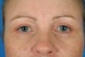 Female who presents with "droopy eyes".