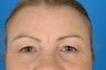 Female who presents with "droopy eyes".