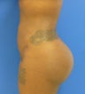 27 y.o. female – Liposuction of abdomen, flanks, and back with fat transfer to buttocks & hips – 1300 cc per side