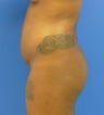 27 y.o. female – Liposuction of abdomen, flanks, and back with fat transfer to buttocks & hips – 1300 cc per side