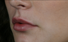 Juvederm Ultra Plus