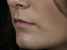 Juvederm Ultra Plus