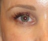 Restylane