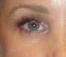 Restylane