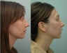 Nose Surgery / Rhinoplasty