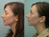 Nose Surgery / Rhinoplasty