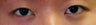 Bilateral Asian Blepharoplasty