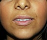 lip augmentation