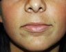 lip augmentation
