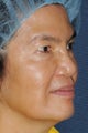 63 year old Asian female with sun damage, brown spots and age spots
