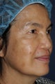 63 year old Asian female with sun damage, brown spots and age spots