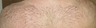 Body to scalp hair transplant - now we can do it with FUE Neograft techniques