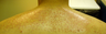 Body to scalp hair transplant - now we can do it with FUE Neograft techniques
