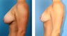 Breast Implant Removal with Internal Lift