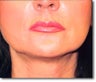 Restylane® and Perlane®