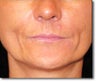 Restylane® and Perlane®