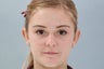 Otoplasty