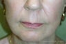 Juvederm®