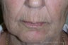 Juvederm®