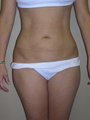 Liposuction