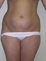 Liposuction