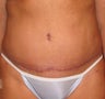 Tummy Tuck
