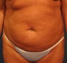 Tummy Tuck