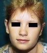 11 year old female patient