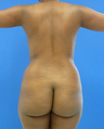 Butt Lift