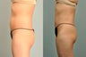 33 year old female Smartlipo abdomen, hips & flanks - 8 months post op