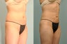 33 year old female Smartlipo abdomen, hips & flanks - 8 months post op