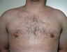 Adult Male treated for Breast Reduction