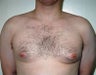 Adult Male treated for Breast Reduction