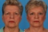 Facelift: 70-Year-Old Woman