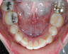 Patient Treated with Invisalign Express