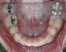 Patient Treated with Invisalign Express