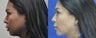 36 year old female treated for weak chin, double chin, and excess buccal fat