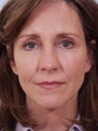 Blepharoplasty
