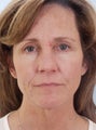 Blepharoplasty