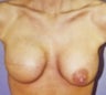 Breast Reconstruction