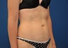 CoolSculpting