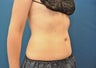CoolSculpting